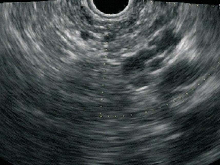 九、異常胰腺聲像圖